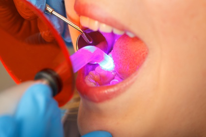 composite-fillings-1 Composite Fillings | Welland Dentistry