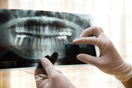 dental-x-ray Digital X-Rays | Welland Dentistry