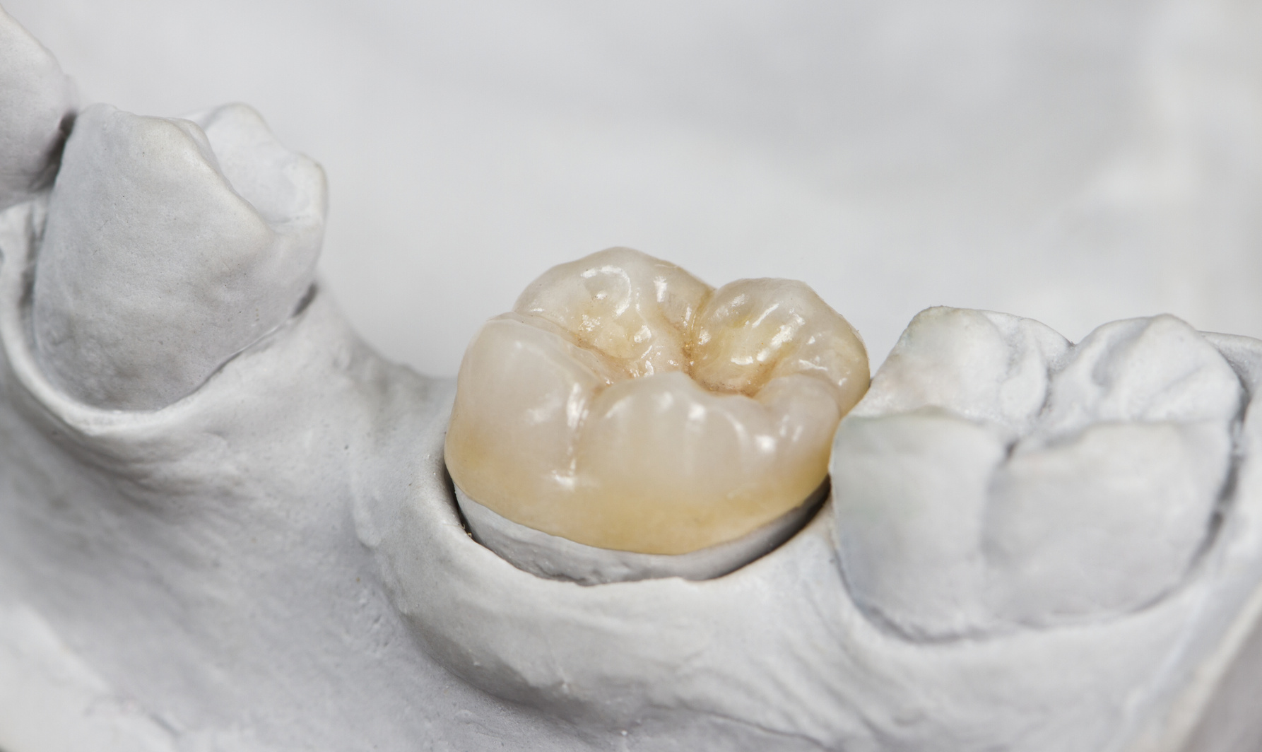 inlay-and-onlay Inlay and Onlay Restorations | Welland Dentistry