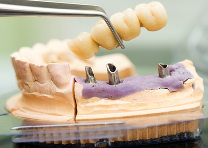 porcelain-fixed-bridges Porcelain Fixed Bridges | Welland Dentistry