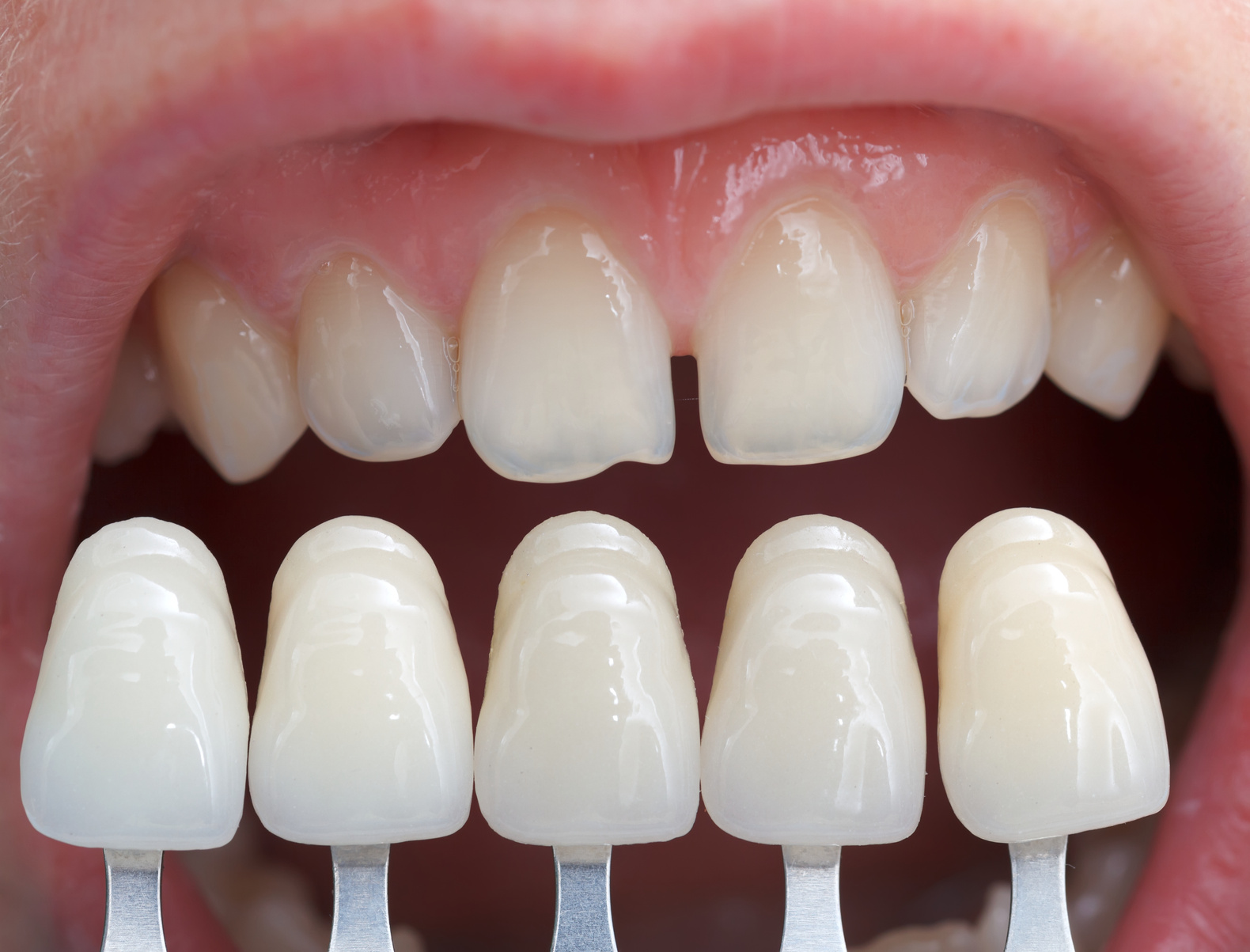 porcelain-veneers Porcelain Veneers | Welland Dentistry