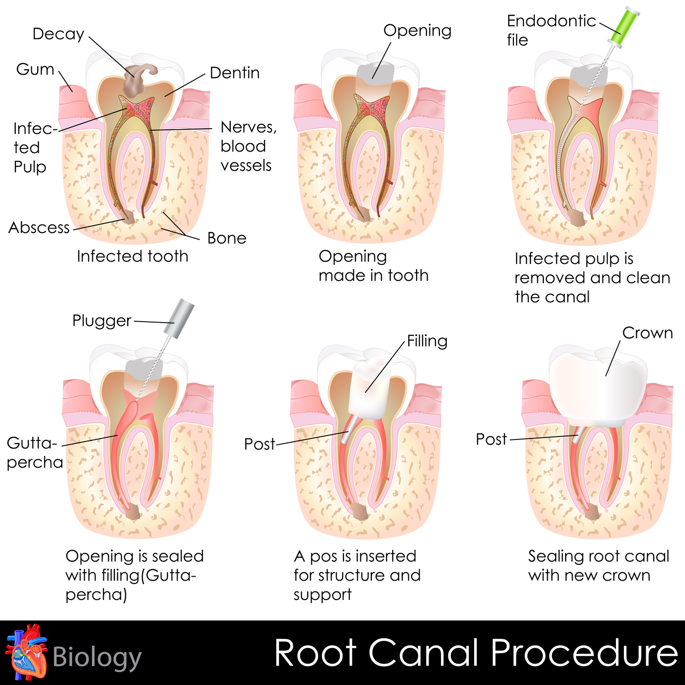 root-canal-treatment Root Canal Treatment | Welland Dentistry